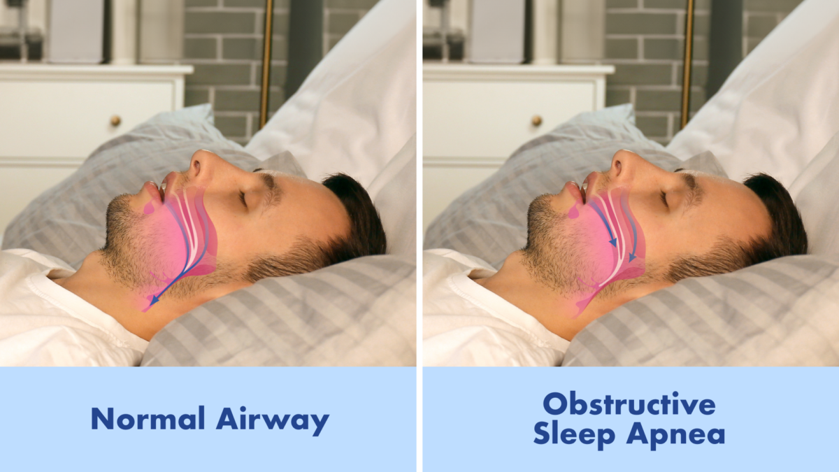 what is cpap therapy a comprehensive guide for sleep apnea patients