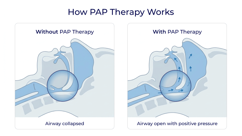 Image 2 In article — How PAP Therapy Works section